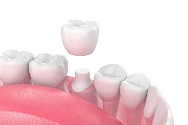 Bọc sứ cải thiện thẩm mỹ và chức năng của răng bị khiếm khuyết, nứt vỡ nhẹ, hở kẽ, ngả màu...
