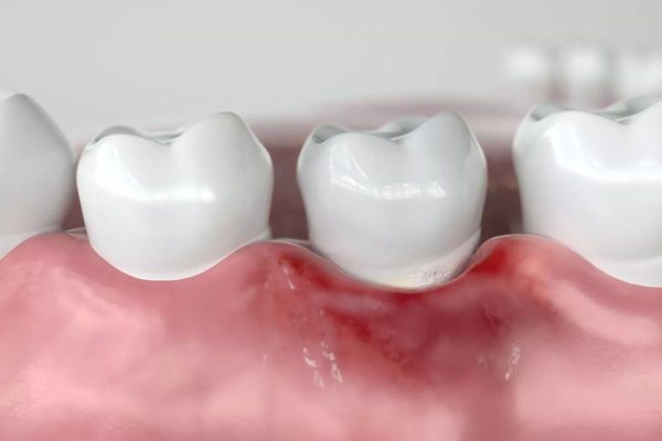 Bọc răng sứ xong bị lung lay có thể do một số bệnh lý răng miệng khiến mão sứ không còn khít với cùi răng thật