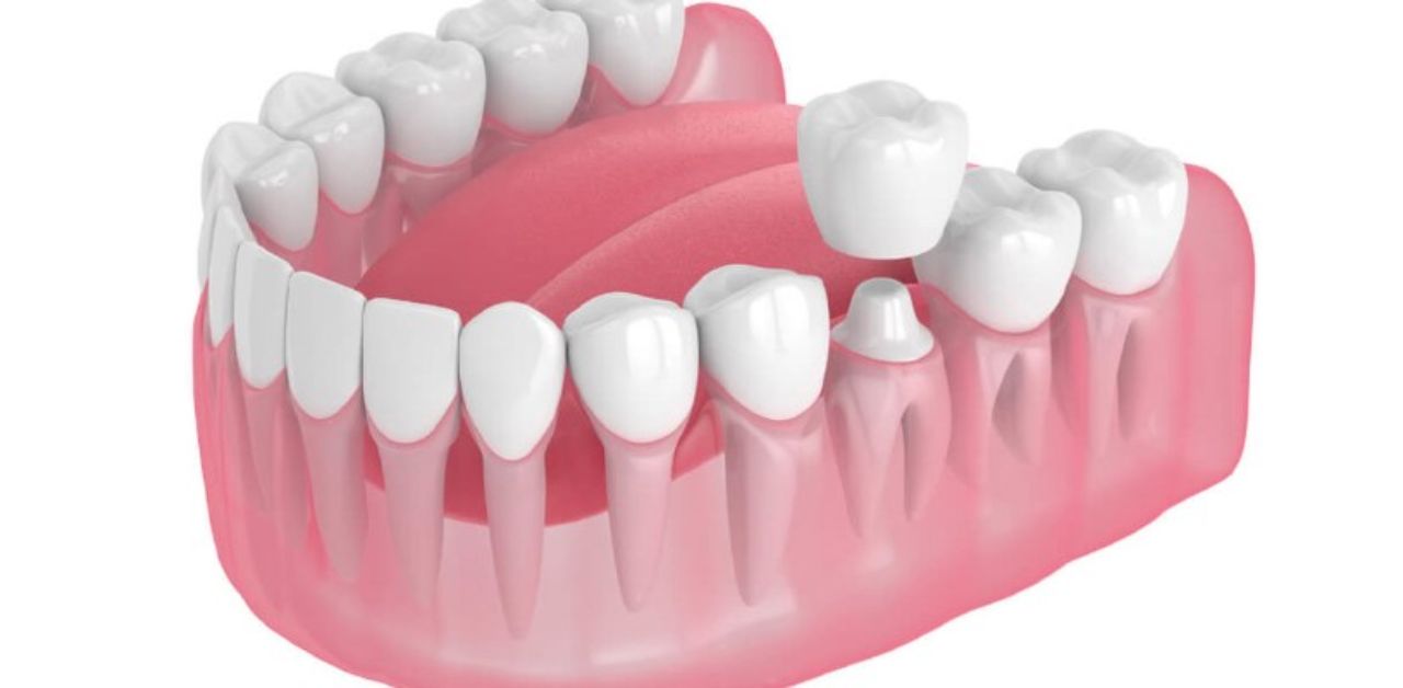 Có những biểu hiện nào cho thấy răng sứ đang lung lay?
