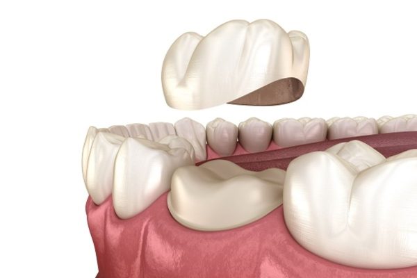 Chụp mão sứ lên trên răng thật và cố định bằng keo dán nha khoa là kỹ thuật bọc răng sứ hiện đại