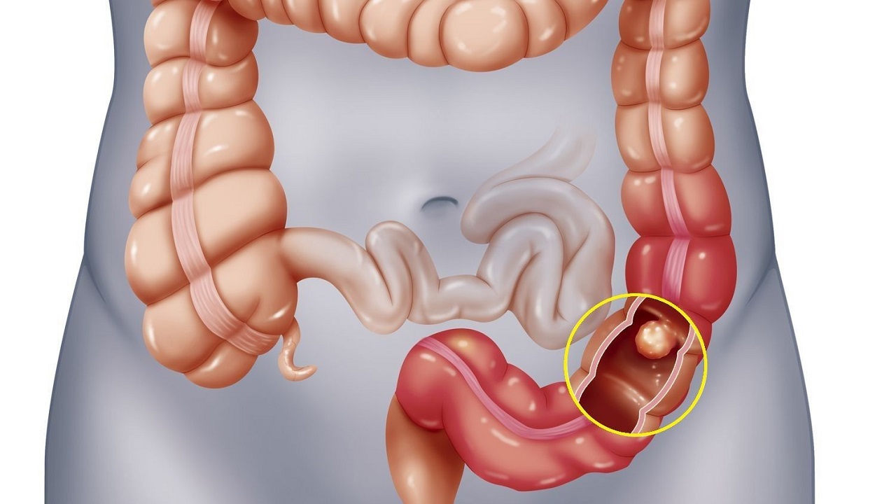 Xét nghiệm CEA có độ chính xác như thế nào trong việc phát hiện ung thư đại trực tràng?
