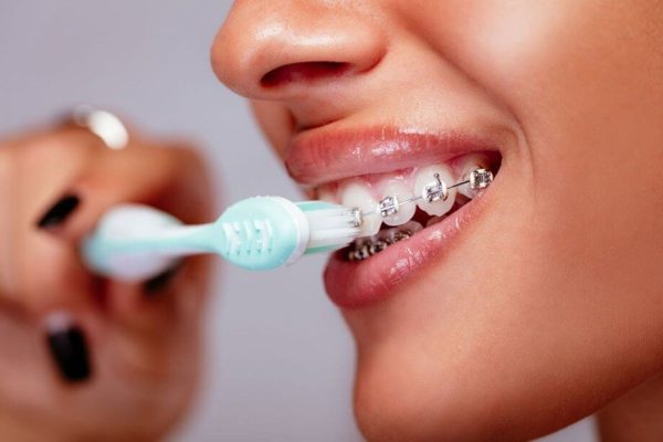 Chăm sóc răng miệng khi niềng răng đúng cách bằng việc chải răng đều đặn 2-3 lần/ngày