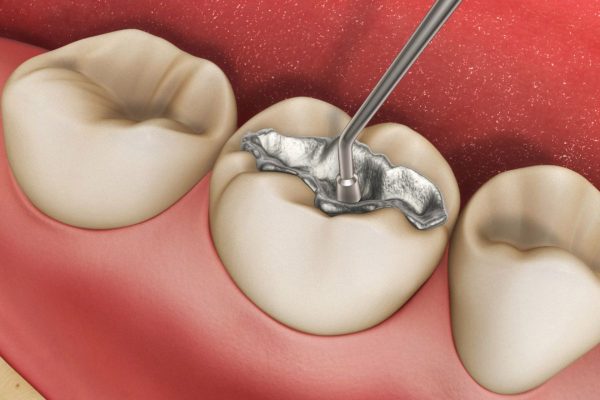 Hàn răng là kỹ thuật trám các chất liệu đặc biệt vào vùng răng bị khuyết do sâu răng, chấn thương nứt vỡ...