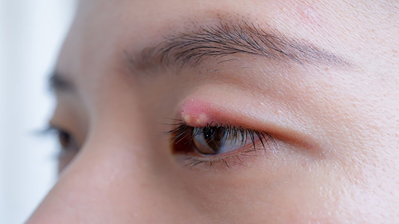 Bác sĩ thực hiện phương pháp mổ chắp mắt như thế nào?