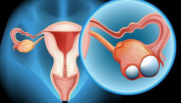 Ung thư buồng trứng thuộc top 5 những bệnh nguy hiểm ở nữ giới