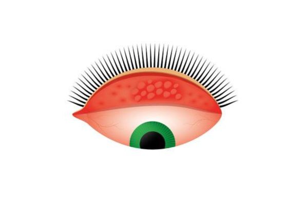 Tình trạng viêm kết mạc, giác mạc do một loại vi khuẩn có tên là Chlamydia Trachomatis gây ra ở mắt được gọi là bệnh đau mắt hột