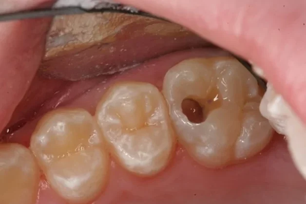 điều trị tủy răng sâu