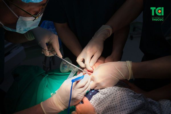 Phẫu thuật dính thắng lưỡi bằng dao Plasma được thực hiện tại Thu Cúc TCI