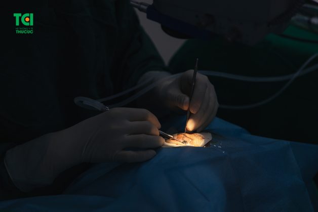 Chuyên khoa Mắt, Bệnh viện ĐKQT Thu Cúc là một trong những địa điểm uy tín nhất Việt Nam áp dụng phương pháp Phaco trong phẫu thuật đục thể thủy tinh