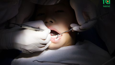 Hàn răng sâu giúp chặn đứng cơn đau sâu răng cho bé 5 tuổi