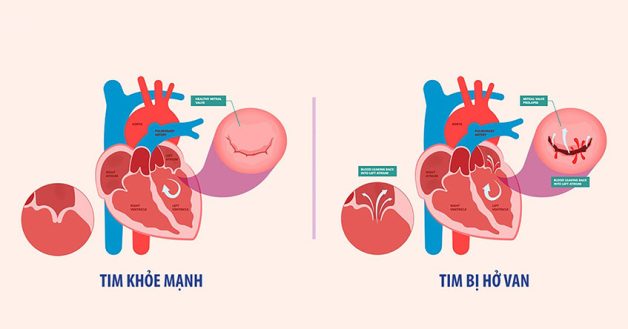 Hở van tim 3 lá là một trong những vấn đề tim mạch mà nhiều người gặp phải