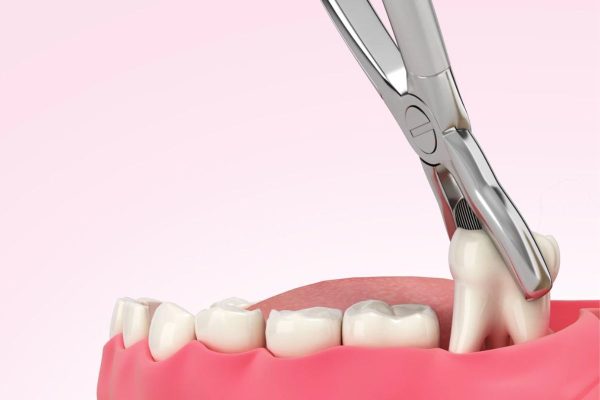 Nhổ răng khôn bằng phương pháp truyền thống sử dụng kìm, cây bẩy để lấy răng ra ngoài