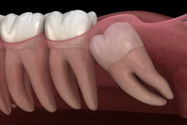 Răng khôn mọc khi mọi người đã có đủ các răng khác trên cung hàm nên gây ra tình trạng mọc lệch, mọc ngầm