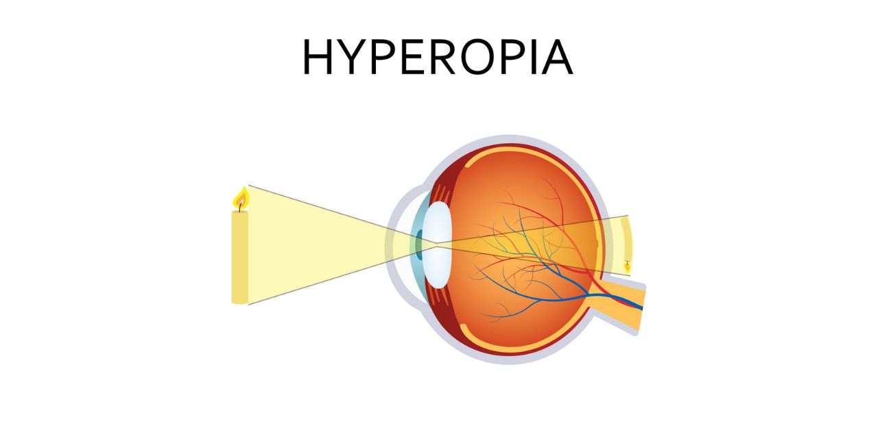 Mắt viễn thị ảnh hưởng đến quá trình nhìn thấy như thế nào?
