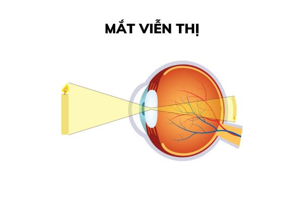 Hình ảnh qua mắt không hội tụ tại võng mạc mà hội tụ ở phía sau võng mạc được gọi là mắt viễn thị