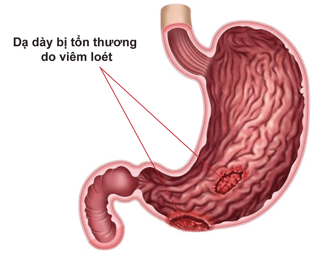 Nguyên nhân loét dạ dày tá tràng, triệu chứng, cách điều trị | TCI ...