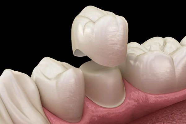 Bọc răng sứ giúp cải thiện hình dáng, kích thước cũng như chức năng của răng