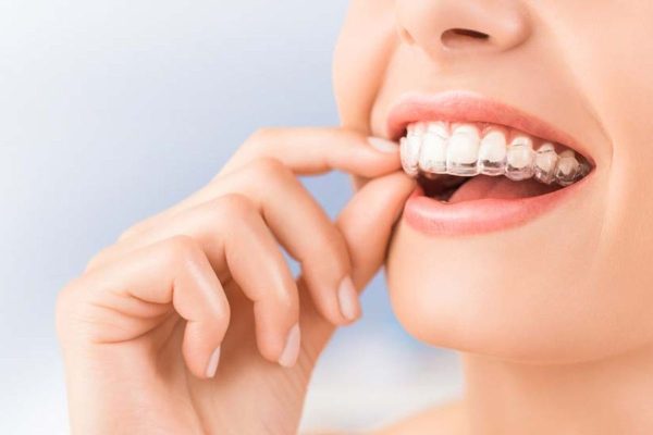 Niềng răng đa dạng các phương pháp như mắc cài kim loại, mắc cài sứ, Invisalign... giúp mọi người sở hữu hàm răng hoàn hảo hơn