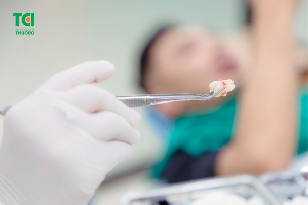Răng khôn được loại bỏ nhanh chóng, dễ dàng mà không gây đau nhức, khó chịu cho người bệnh