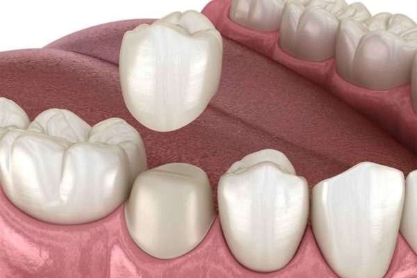 Phương pháp bọc răng sứ, cải thiện hiệu quả tình trạng răng nhiều khiếm khuyết