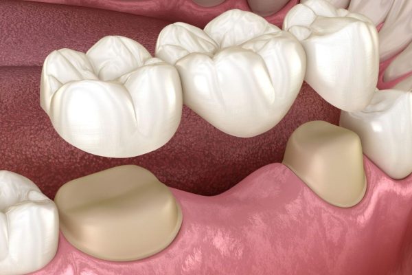 Bắc cầu răng sứ, một trong những giải pháp hoàn hảo cho những người bị mất răng