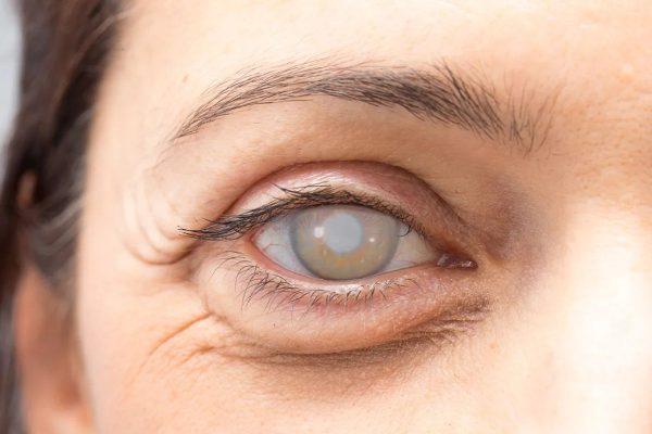 Đục thủy tinh thể, nguyên nhân hàng đầu gây suy giảm thị lực, mù lòa ở người lớn tuổi