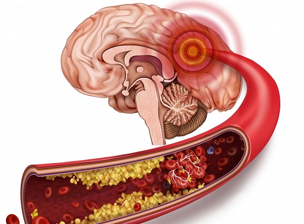 Tắc mạch máu não: Nguyên nhân, triệu chứng và cách xử trí | TCI ...