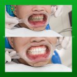 Tạm biệt hàm răng ố vàng hơn 5 năm nhờ tẩy trắng răng nha khoa