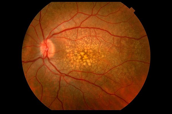 Sự thoái hóa của các tế bào điểm vàng khiến mắt mất khả năng nhìn chi tiết ở trung tâm thị giác được gọi là thoái hóa hoàng điểm