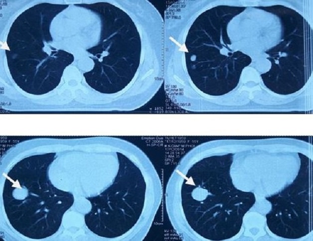 Tìm hiểu về tầm soát ung thư phổi bằng CT liều thấp | TCI Hospital