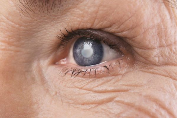 Triệu chứng glocom góc đóng đơn cấp thường thấy là đau nhức mắt, phù nề giác mạc, tiền phòng giảm trong, thị lực kém...