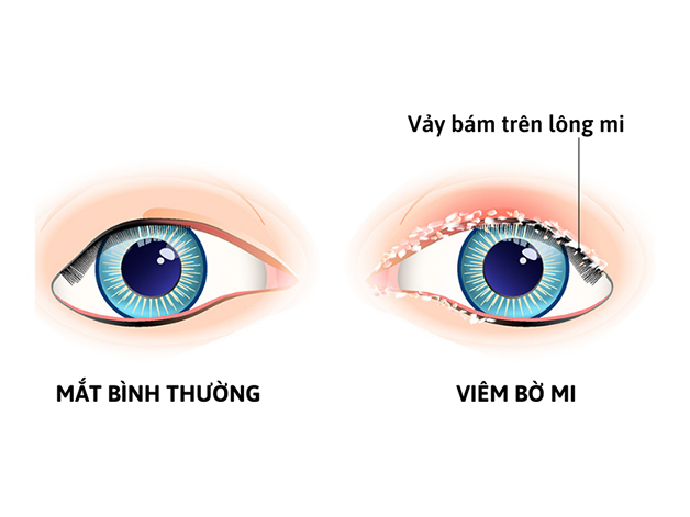 4. Viêm Bờ Mi Có Lây Không?