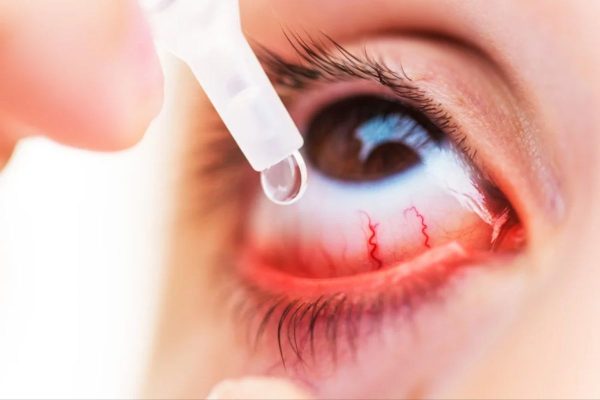 Điều trị viêm kết giác mạc do vi khuẩn gây ra bằng thuốc nhỏ mắt có chứa kháng sinh