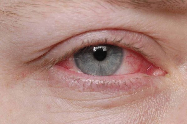 Viêm kết mạc, giác mạc là bệnh truyền nhiễm cấp tính, diễn ra ở vùng kết mạc và giác mạc của mắt