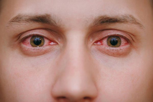 Đỏ mắt, chảy nước mắt... là những biểu hiện thường thấy ở những bệnh nhân có kết mạc, giác mạc bị viêm nhiễm