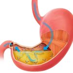 Bệnh loét hang vị dạ dày: nguyên nhân, triệu chứng và cách điều trị