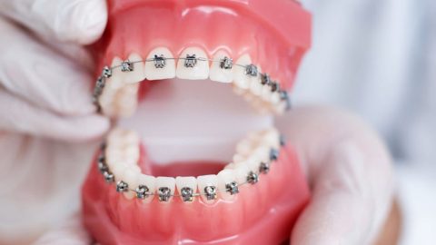 Viêm lợi khi niềng răng: Nguyên nhân và cách điều trị