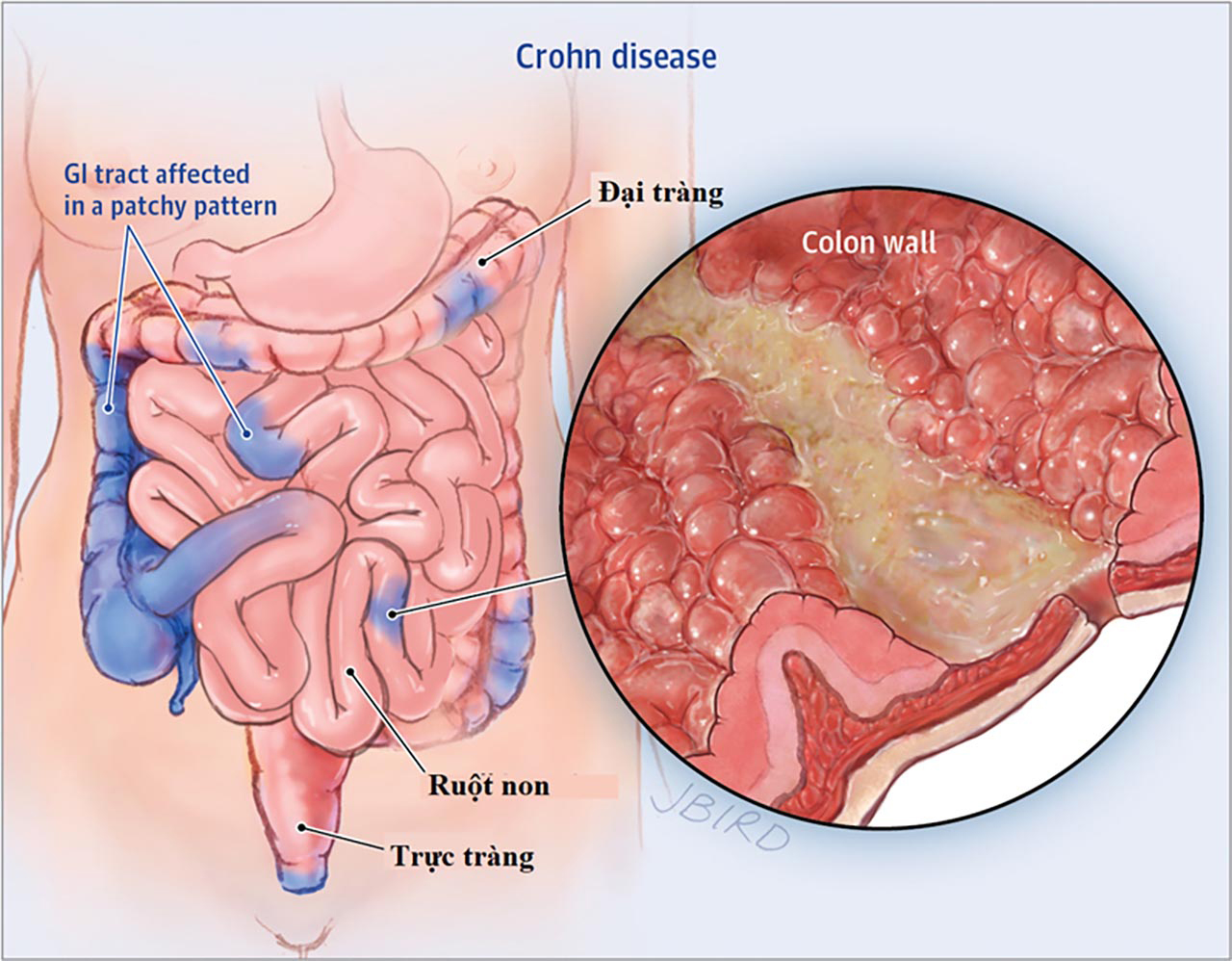 Tổng quan nguyên nhân, triệu chứng và cách điều trị bệnh crohn