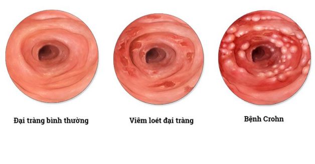 Hình ảnh nội soi đại tràng của bệnh nhân nhiễm crohn
