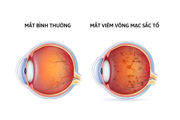 Viêm võng mạc sắc tố: Nguyên nhân, triệu chứng và phương pháp điều trị