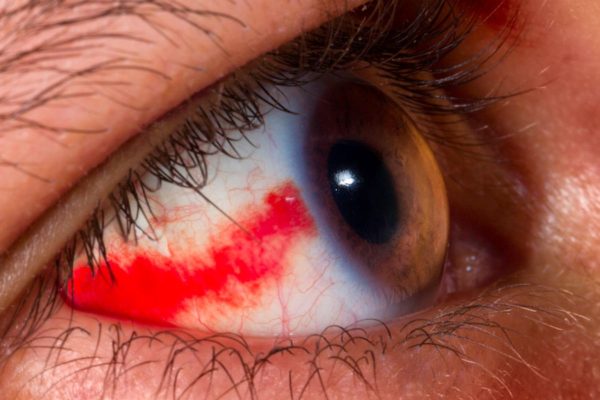 Tổn thương mạch máu ở mắt là nguyên nhân hàng đầu khiến dịch kính bị xuất huyết