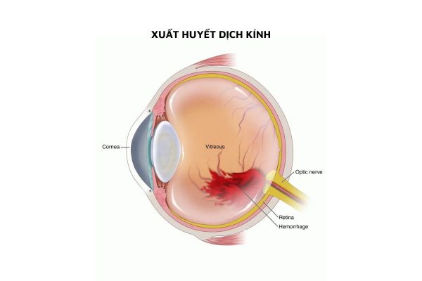 Tình trạng máu chảy vào khoang chứa dịch kính của mắt và hòa lẫn với dịch kính gọi là xuất huyết dịch kính