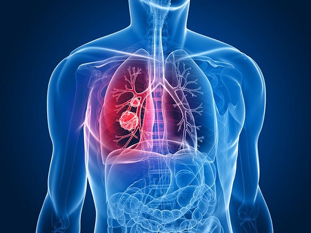 nguyên nhân ung thư phổi