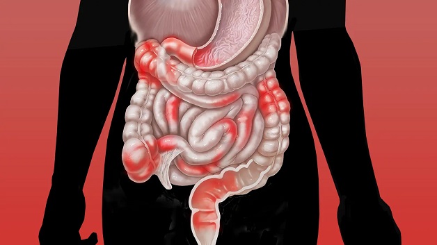 Biến chứng bệnh Crohn