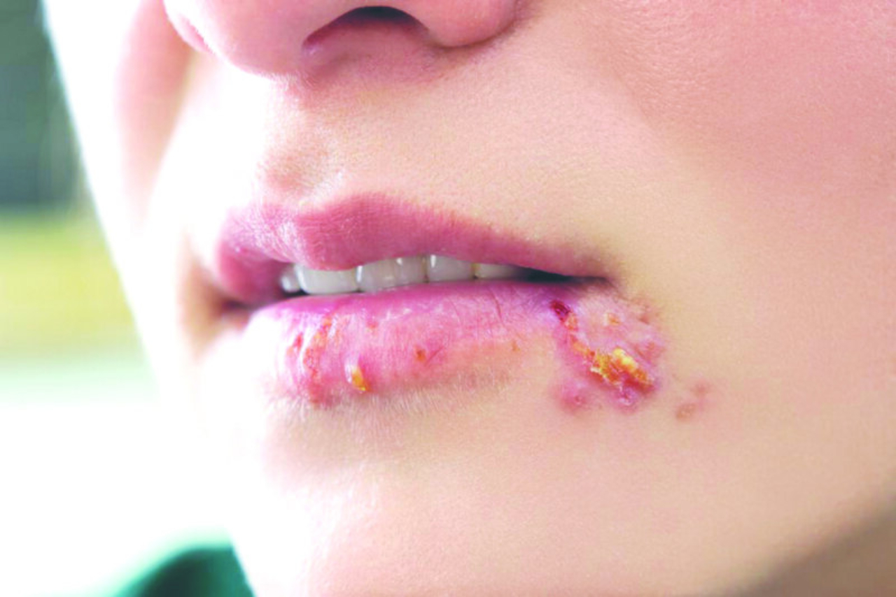 Nếu bị bệnh herpes môi, cần phải làm gì? 
