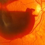 Bệnh xuất huyết dịch kính: Tiềm ẩn nguy cơ mù lòa vĩnh viễn