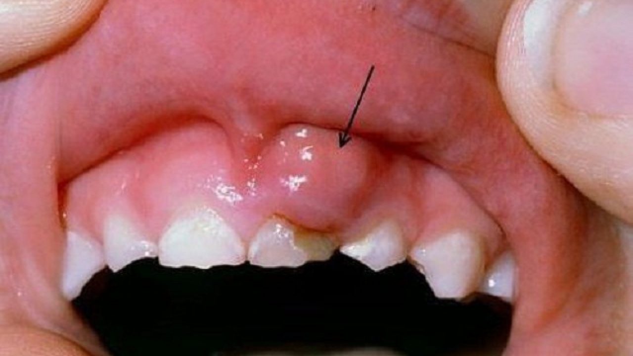 Nắm bắt nguyên nhân gây sưng nướu răng do sâu răng?
