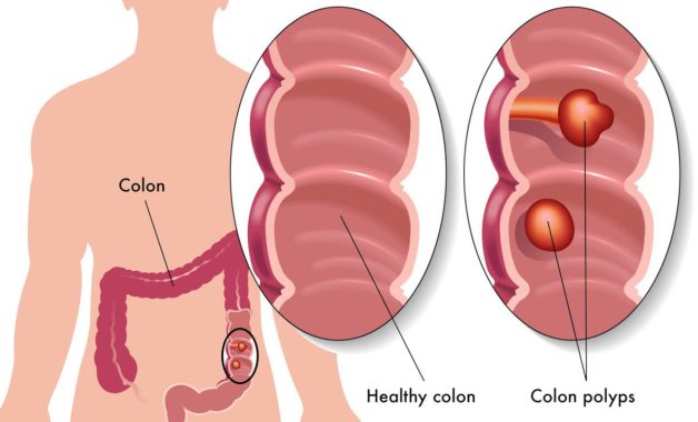 cat polyp dai trang1 e1666536004379