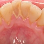 Chuyên gia giải đáp: Có cần thiết phải lấy cao răng không?