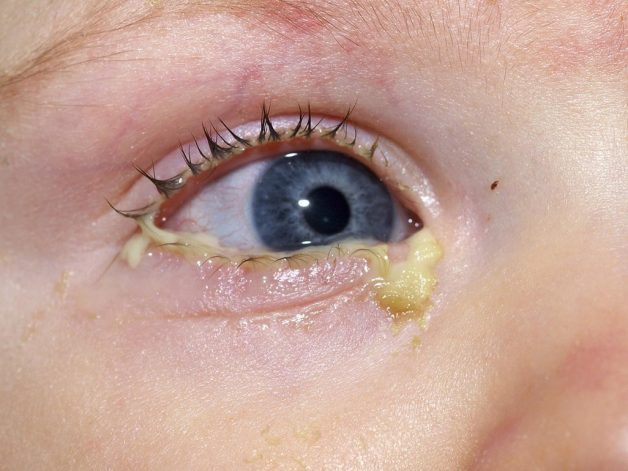 Người bị đau mắt đỏ lâu ngày không khỏi do cầu khuẩn sẽ chảy mủ nhiều